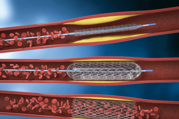 Peripheral and Aortic Angioplasty & Stenting
